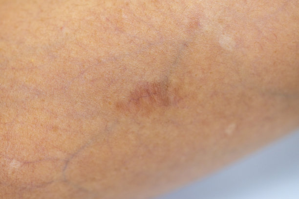 身体不同部位的伤疤。图片下载