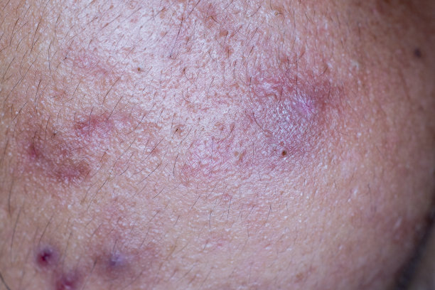 临床上因面部痤疮引起的皮肤病变。图片下载