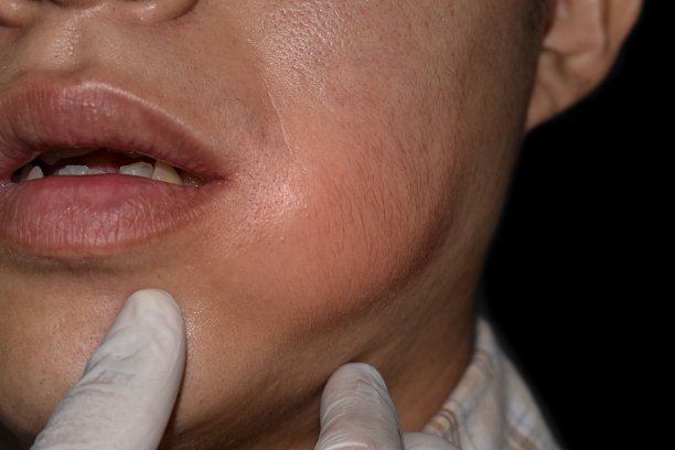 亚洲男人脸颊肿胀。脓肿形成。图片下载