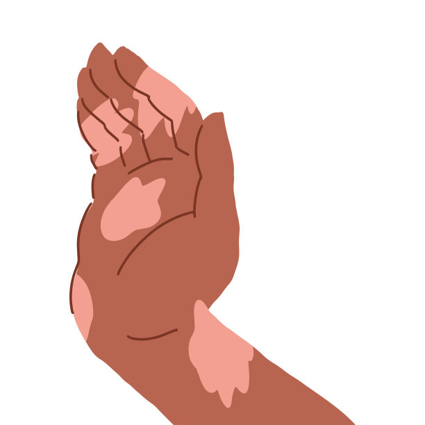 手掌张开，褐色皮肤上有白癜风补丁图片下载