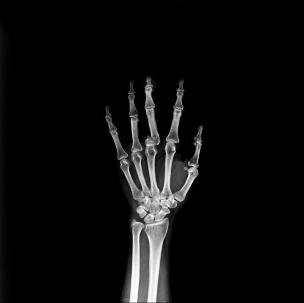 x线多片x线骨折指和铝夹板图片下载