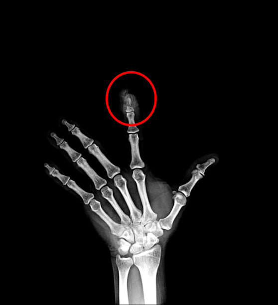 x线多片x线骨折指和铝夹板图片下载