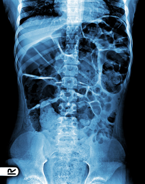肠胃气胀。腹部x线AP(前后x线摄影)图片下载