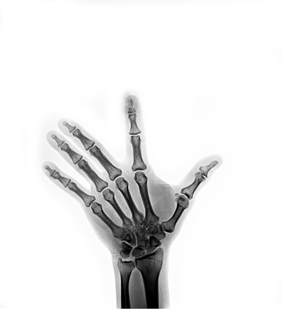 x线多片x线骨折指和铝夹板图片下载