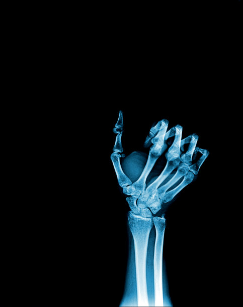 x线多片x线骨折指和铝夹板图片下载