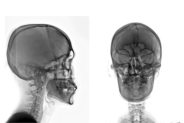 正常人类颅骨AP x光片。图片下载