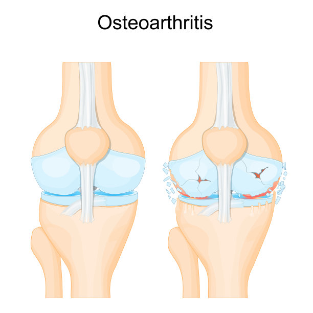 膝骨关节炎。退行性关节病图片下载
