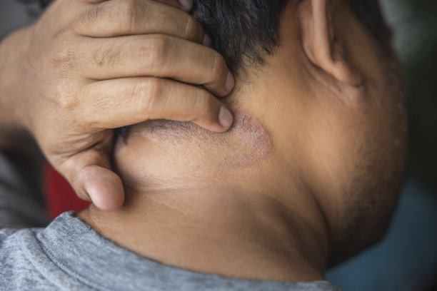 皮肤黝黑的亚洲男性会因为引起水分的真菌而患上头皮皮炎。真菌瘙痒。皮肤疾病——过敏、牛皮癣、湿疹、皮炎。图片下载