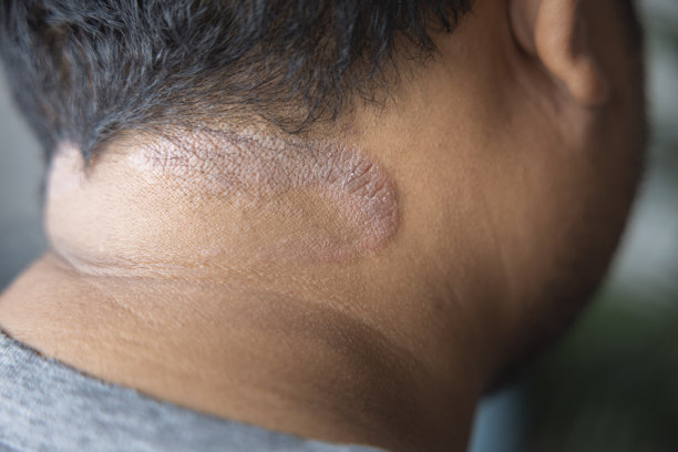 皮肤黝黑的亚洲男性会因为引起水分的真菌而患上头皮皮炎。真菌瘙痒。皮肤疾病——过敏、牛皮癣、湿疹、皮炎。图片下载