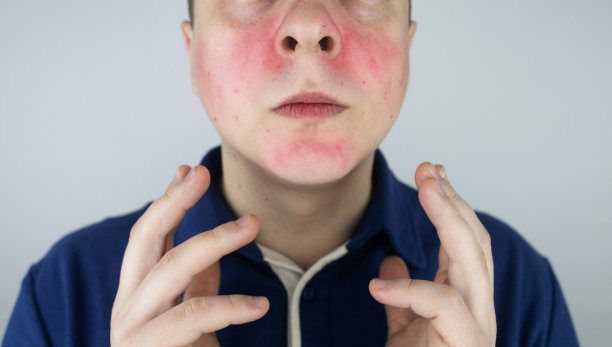 酒渣鼻的脸。这个男人脸颊发红。皮的偶糖。面部可见红肿及毛细血管网。治疗和移除。血管外科和皮肤科图片下载