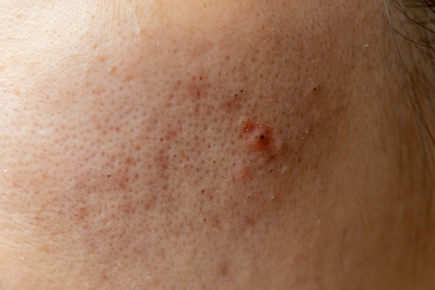 面部粉刺问题图片下载