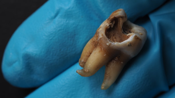 蛀牙和牙医手手套和黑色背景。牙科医生拔牙后的蛀牙至牙根的微距照片。真实的牙齿解剖，由于缺乏牙齿护理。龋齿俯视图图片下载