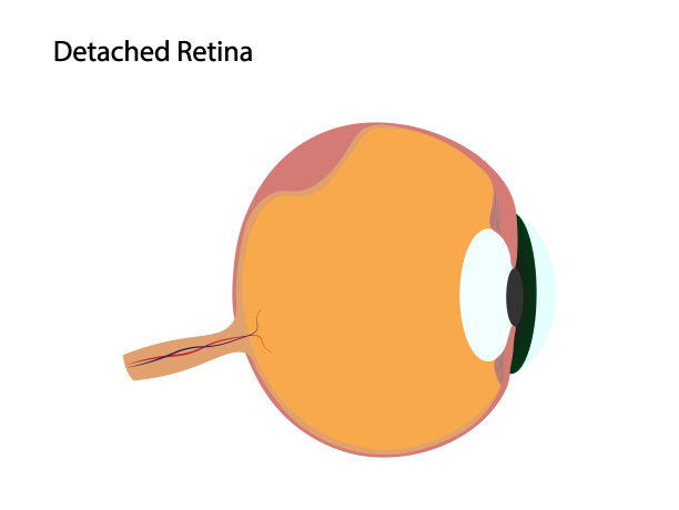 视网膜脱离插图。视网膜脱落的眼睛图片下载