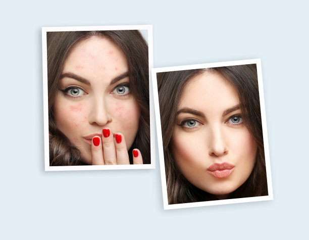 痤疮后印记。治疗痤疮疤痕。祛痘疤痕图片下载