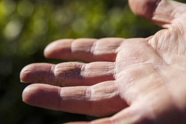 手掌有健康问题的手部皮肤图片下载