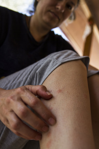 被蚊子叮咬的腿图片下载