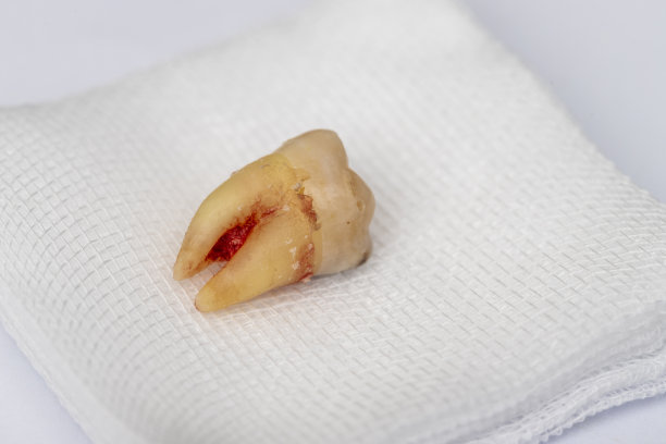 蛀掉的臼齿被拔掉了。血还没干呢。躺在白纱布上。孤立在白色背景上。有选择性的重点。图片下载