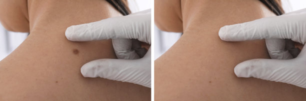 抽痣手术前后病人背部照片拼贴，特写。皮肤科医生正在检查女性皮肤图片下载