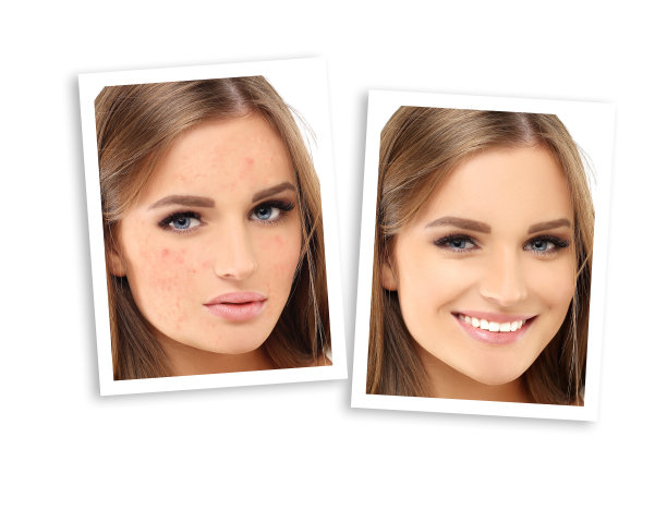 痤疮后印记。治疗痤疮疤痕。祛痘疤痕图片下载