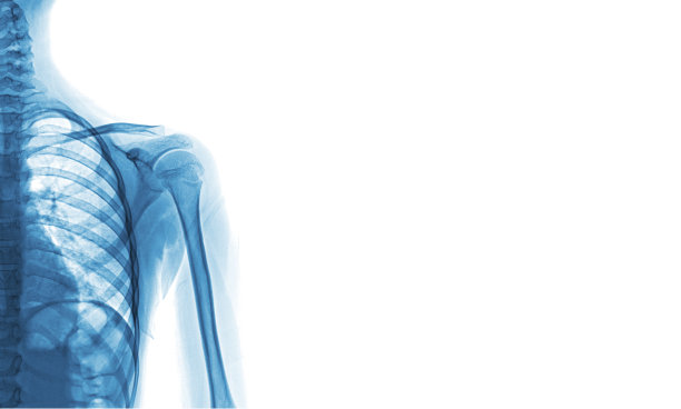 用于医学诊断的肩部x光图像。图片下载