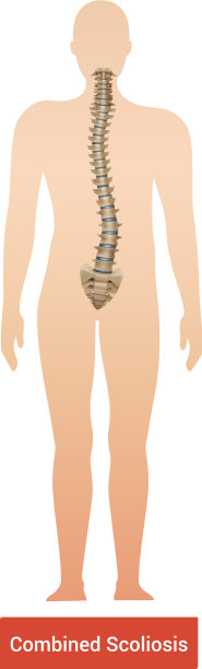 脊柱合并脊柱侧凸图片下载