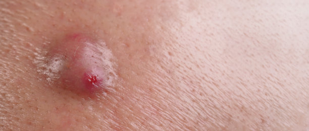 细菌性皮肤感染。大粉刺囊肿、脓肿或溃疡面部皮肤组织内的肿胀区域。含脓和血的。面部近口痤疮或皮炎微距照片。护肤品。图片下载