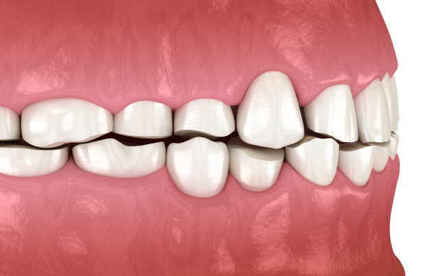 牙齿磨蚀(磨牙症)导致牙齿组织丧失。牙科3D插图图片下载