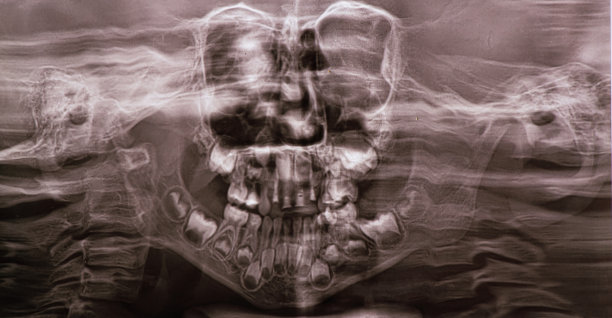 全景图显示在儿童牙齿的上颌和下颌都有几颗嵌牙和阻生牙。图片下载