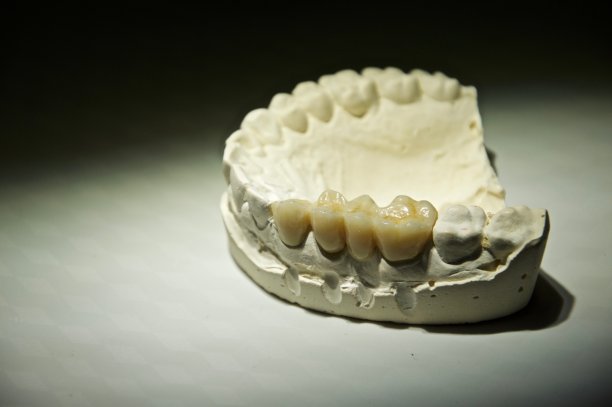 石膏牙弓上的牙桥图片下载