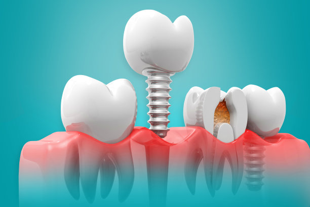 种植牙，健康的牙齿和种植牙，三维插图图片下载