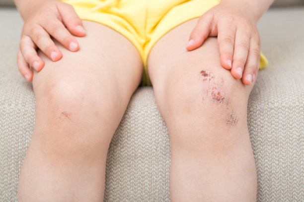 幼童膝盖擦伤皮肤。孩子坐在家里的沙发上。特写镜头。前视图。图片下载