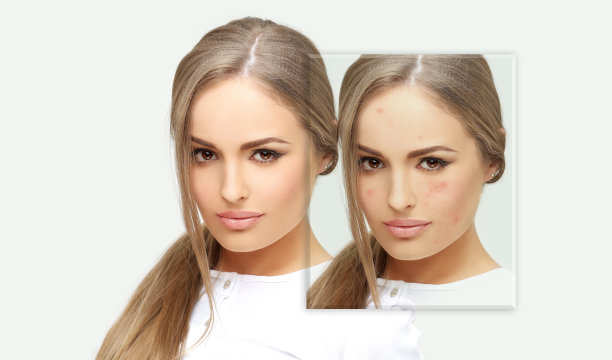 痤疮后印记。治疗痤疮疤痕。祛痘疤痕图片下载