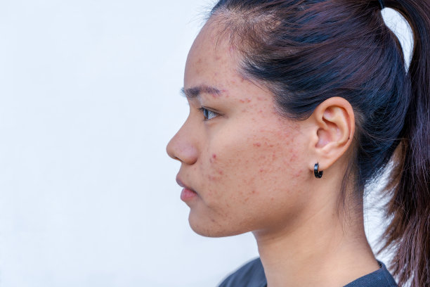 近距离的年轻亚洲妇女担心她的脸，当她有问题的皮肤在她的脸。女性皮肤上有痤疮和疤痕。问题护肤与健康理念。图片下载