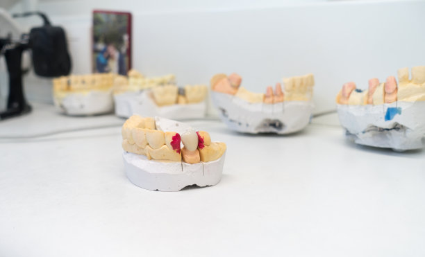 牙科模型上的金属陶瓷冠图片下载