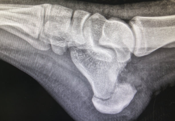 跟骨骨折(脚跟骨折)x线片图片下载