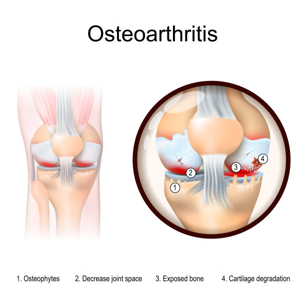 有关节炎症状的膝关节特写图片下载