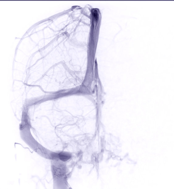脑静脉造影诊断脑静脉血栓形成图片下载