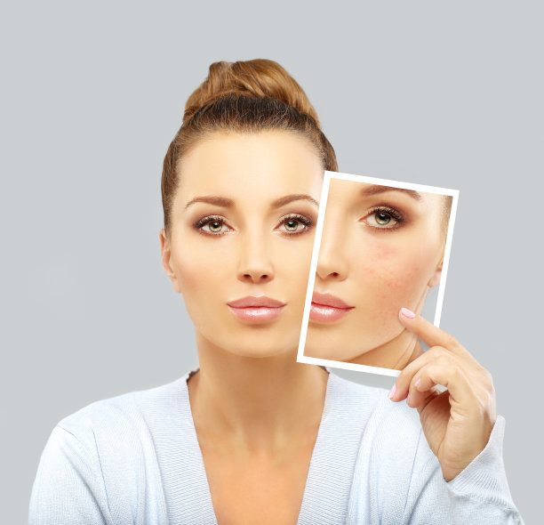 痤疮后印记/治疗痤疮疤痕图片下载