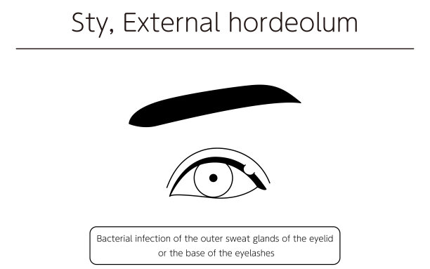 医学剪贴画，线图说明眼病和麦粒肿，外疣图片下载