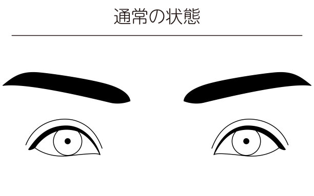 医学插图、眼病、斜视及正常情况的图解线图图片下载