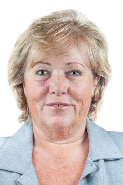 正在从皮肤癌手术中恢复图片下载