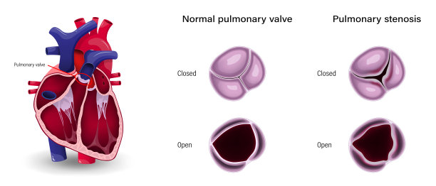 心脏瓣膜病。肺动脉瓣狭窄与正常肺动脉瓣的区别。图片下载