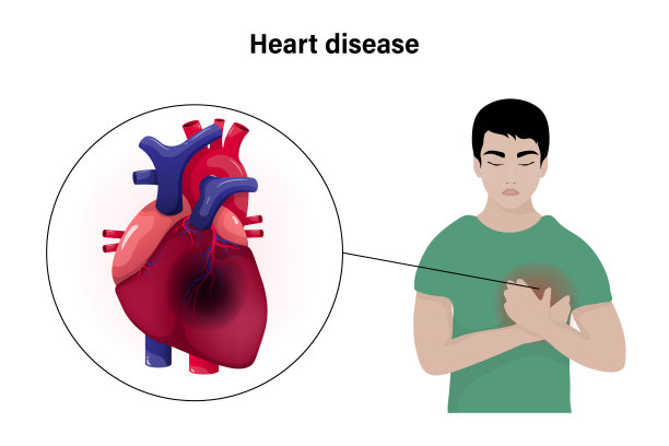 心脏病病媒概念。有心脏病发作症状的男子。图片下载