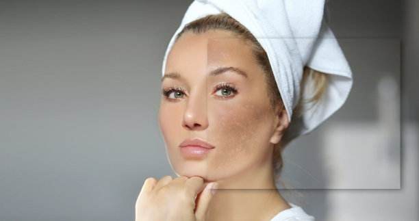 黑斑，雀斑，色素沉着(黄褐斑或黄褐斑)，概念-皮肤提亮，皮肤美白，果酸，AHA，皮肤提亮图片下载