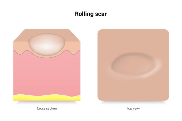 滚动的疤痕。面部皮肤问题。关于美容和医疗的广告载体。图片下载