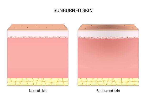晒伤的皮肤。正常皮肤与晒伤皮肤的比较。面部皮肤问题。关于美容和医疗的广告载体。图片下载