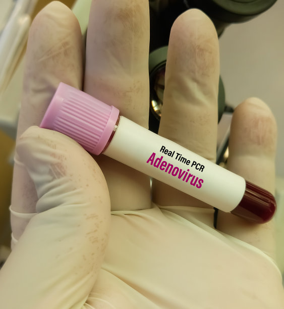 血液样本进行实时腺病毒检测以诊断腺病毒感染。PCR检测。图片下载