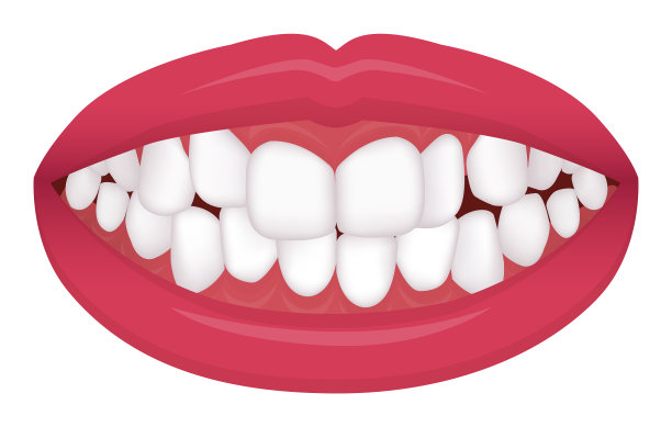 牙齿毛病咬合型牙齿歪斜拥挤图片下载