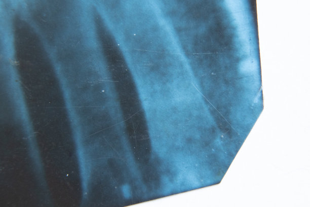 骨质疏松症和关节关节炎，骨质破坏的老年人x光片图片下载