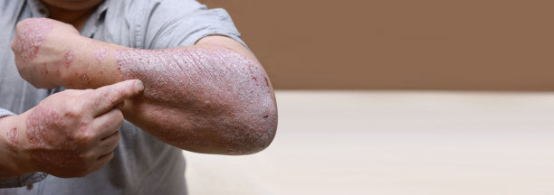 急性形式的牛皮癣皮肤。男性显示手臂有裂纹，硬，角质，片状皮肤。过敏、湿疹等皮肤病问题。手渍，皮疹，皮肤干燥。慢性病的概念图片下载